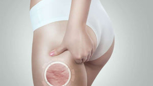 20 Remedios Naturales para la Celulitis