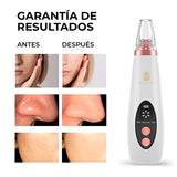 Turbo Removedor De Espinillas Limpiador Poros, Tecnología más nueva 6 sondas 3 niveles de succión Eliminación de espinillas Máquina limpiadora de piel de succión fuerte con el Kit Removedor de Espinillas para Mujeres y Hombres removedor puntos negros, Acn