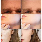 Dermaroller Facial 0.5mm 540 Rodillo Micro Agujas Titanio para Cuidado de la Piel Mesoterapia,Reducir la Hiperpigmentación,Reducir Ojo Líneas Finas, Crecimiento del Cabello