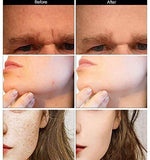 Dermaroller Facial 0.5mm 540 Rodillo Micro Agujas Titanio para Cuidado de la Piel Mesoterapia,Reducir la Hiperpigmentación,Reducir Ojo Líneas Finas, Crecimiento del Cabello