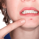 BÁLSAMO DE BENJUÍ ANTI-ACNÉ  30ML.